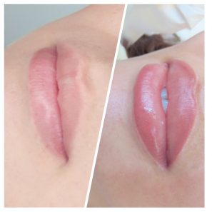 Dudak kontür işlemi sonrası bir kadının dudakları