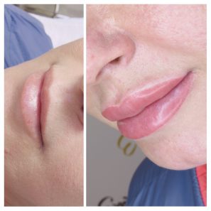 Pembe dudaklı bir kadının dudak kontür öncesi ve sonrası