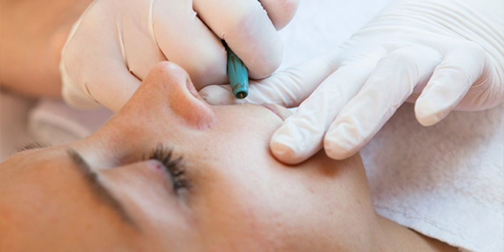 Gözü kapalı bir kadının yüzü ve dudak üstünde iğneli epilasyon cihazı