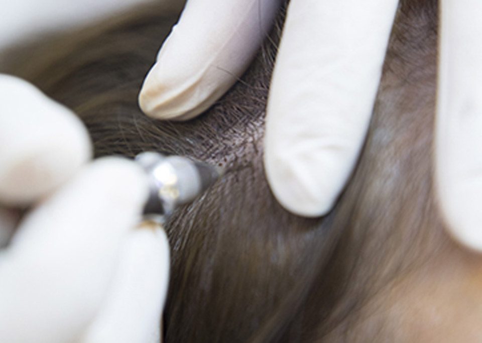 Saç derisine saç simülasyonu işleminin uygulanışı