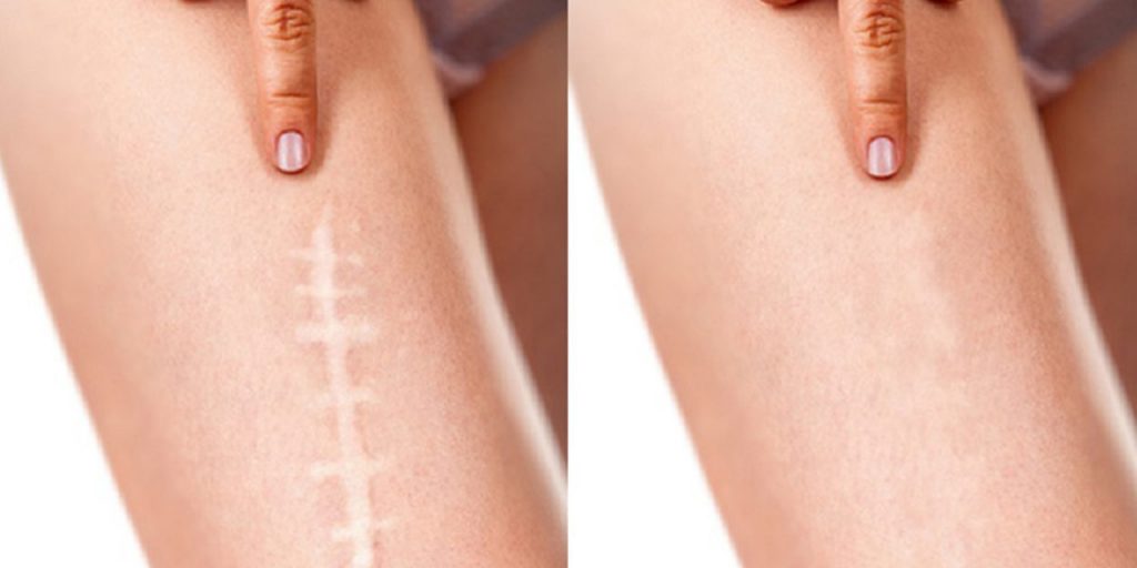 bacağındaki yara izini gösteren kadın ve aynı yara izinin iyileşmiş hali